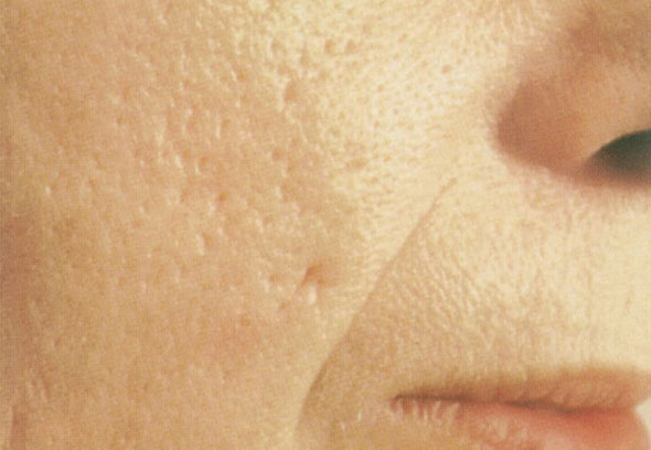 Acne post