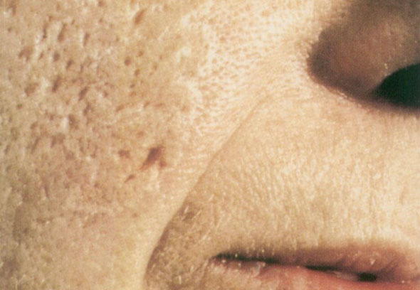 Acne pre