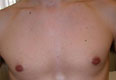 Chest post