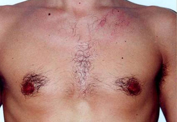 Chest pre