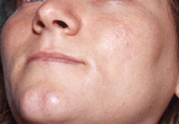Face post